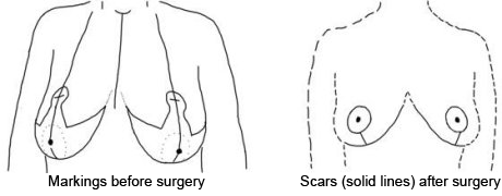 Craig S Rock, MD - Houston Plastic Surgeon - Breast Reduction