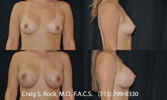 Breast Augmentation Using Cohesive Silicone Implants - Patient 1