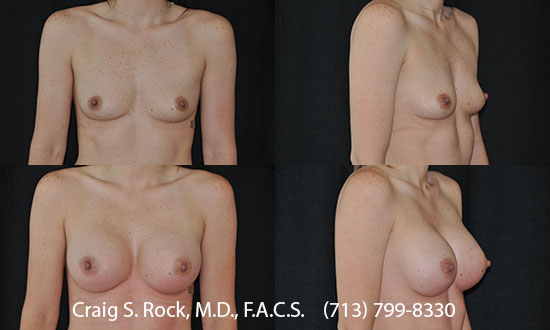 Breast Augmentation Using Cohesive Silicone Implants - Patient 3