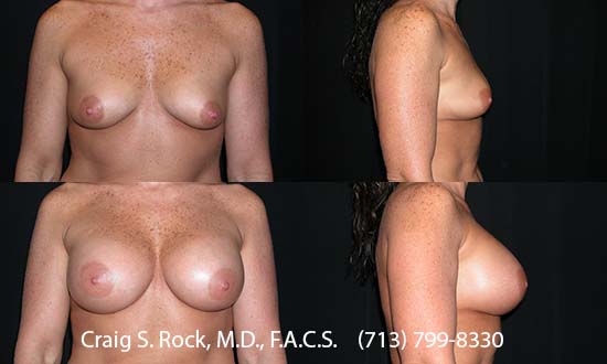 Breast Augmentation Using Silicone Implants - Patient 1