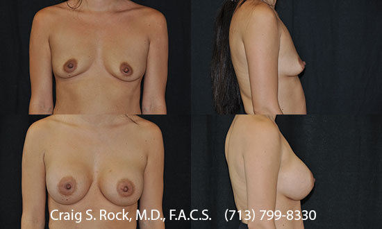 Breast Augmentation Using Silicone Implants - Patient 14